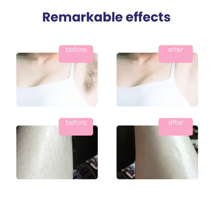 Laser Hair Removal Device Auto Mode With Warranty